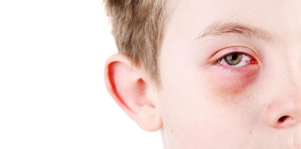 boy with pink eye